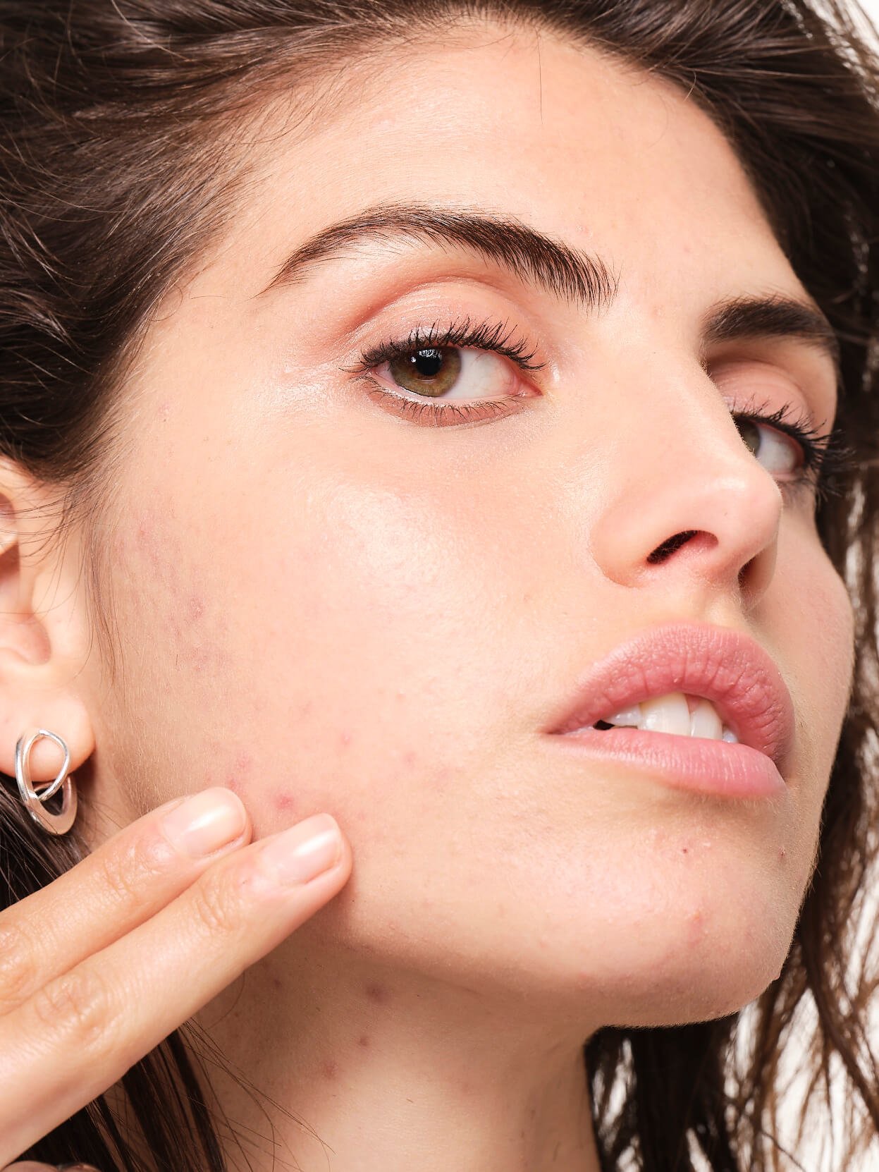 can-food-cause-acne