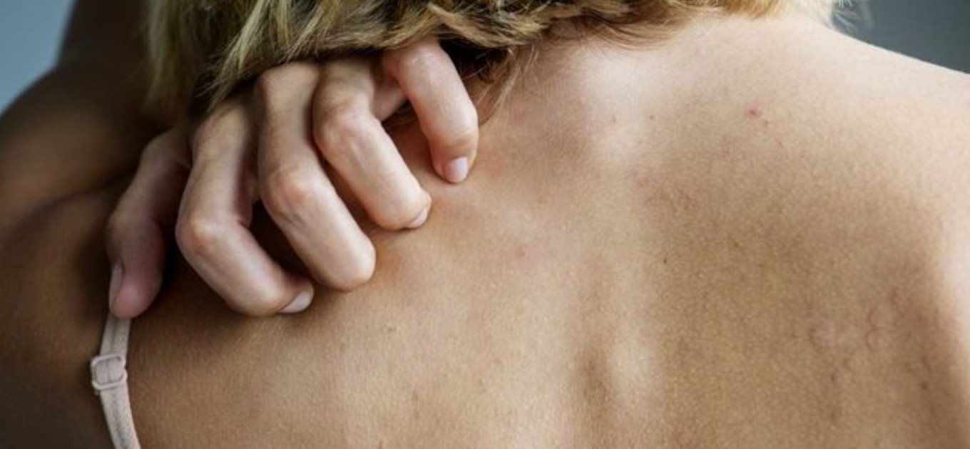 Dlaczego podczas menopauzy alergie skórne są częstsze oraz jak je złagodzić?