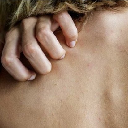 Dlaczego podczas menopauzy alergie skórne są częstsze oraz jak je złagodzić?