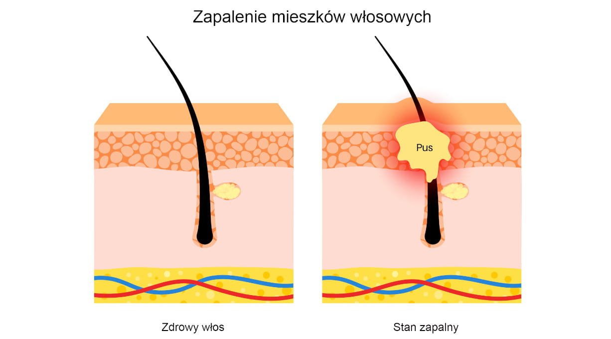 Grafika przedstawiająca zdrowy włos i zapalenie mieszka włosowego