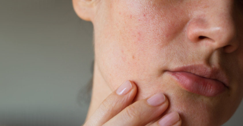 Skóra z niedoskonałościami - jak stosować kwas salicylowy