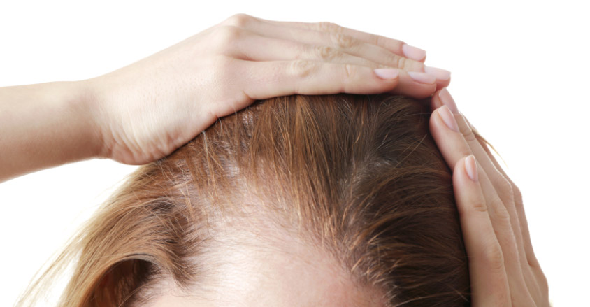 Widoczne łysienie trakcyjne na skroniach