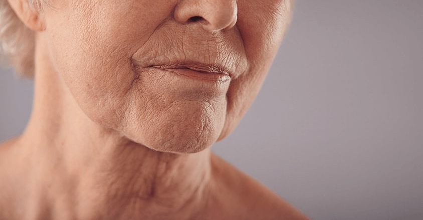 Zmarszczki nosowo-wargowe u dojrzałej kobiety