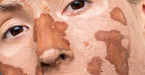 Przesuszona skóra – czym różni się od suchej?