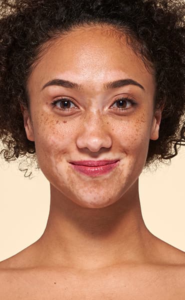 v_anim-vitiligo_1.jpg